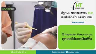 ปลูกผมถาวรแบบไม่ต้องโกนผม (Non shaven FUE ) I Hairtran Clinic