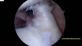 L Shoulder Biceps Tendon Tear Surgery 2018 11 29 JP