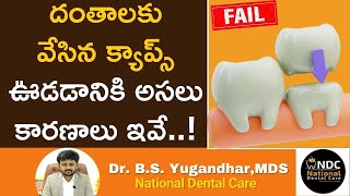 డెంటల్‌ క్యాప్‌ ఫెయిల్‌ అవడానికి కారణాలు || Reasons Why Dental Crown Fail || NDC