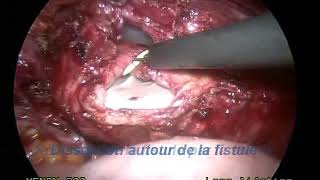 VVF: laparoscopic repair of vesico-vaginal fistulae