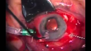 Posterior Chamber Intraocular Lens Suturing and Anterior Chamber Intraocular Lens Removal