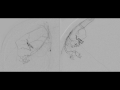 endovascular embolization of dural arteriovenous fistula