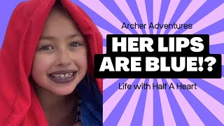 BLUE LIPS?! CYANOSIS | life with HALF A HEART (HLHS)