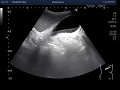 Ultrasound Video showing stone and sludge in Gall bladder with a small hepatic hemangioma.