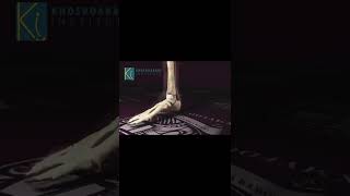 How to Treat Flat Foot Deformity