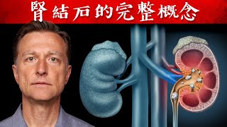 腎結石的完整概念,不應該吃什麼食物？自然療法,柏格醫生 Dr Berg