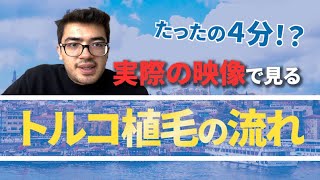 【トルコ植毛】これさえ見れば完璧！現地から植毛まで（実際の映像付き）