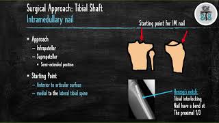 Tibial Shaft Fracture