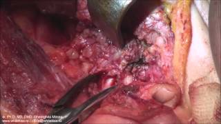 Parotidectomy