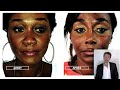 rhinoplastie ultrasonique résultat sur nez caucasien et sur nez africain