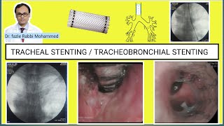 Tracheal stent placement at SQUARE HOSPITAL LTD Dhaka #BD_ENDOSCOPY