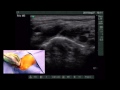 Ultrasound-guided supraclavicular subclavian vein catheterization In Children 1