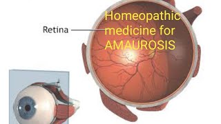 Homeopathic Medicine For AMAUROSIS|All About Homeopathic Medicine For AMAUROSI#viralvideo