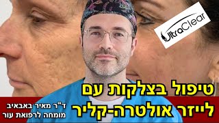 טיפול מהפכני בצלקות עם לייזר אולטרה-קליר: חידוש העור בידיים של מומחה