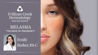 Melasma - The Mask of Pregnancy