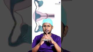 Fallopian Tube Recanalization explained by Dr.Arul !!