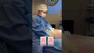 Extended Tummy Tuck Explained