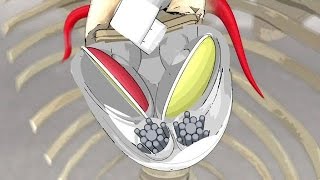 Artificial hearts