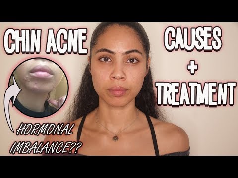 Chin Acne: Why You're Getting It & How To Prevent It Naturally Chin Acne: Why You're Getting It & How To Prevent It Naturally