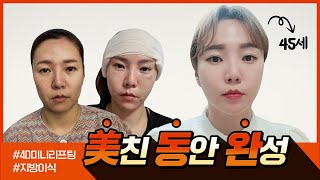 미니리프팅으로 땅콩형 얼굴🥜 탈출하고 동안외모까지 얻었어요☺ #성형전후 #성형후기