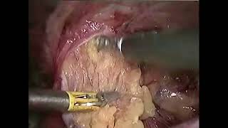 E tep for irreducible inguinal hernia