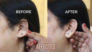 कान का छेद छोटा करे इस नुस्खे से सिर्फ एक दिन में करें | Make Ear Holes Smaller