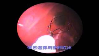 犬 內視鏡胃異物取出術 (胃鏡撈網神器) Endoscopic foreign body retrieval (with basket)