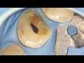 RCT on a Vital premolar using Aurum Blue (metabiomed)