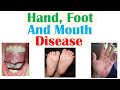 Hand, Foot and Mouth Disease | Viruses, Pathophysiology, Signs and Symptoms, Diagnosis, Treatment