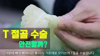 턱끝수술중 T절골수술 모의수술을 통한 설명