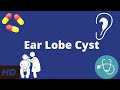 Ear Lobe Cyst: Everything You Need to Know