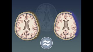 Craniectomy vs. Craniotomy for Acute Subdural Hematoma | NEJM