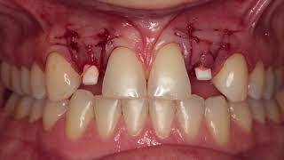 Surgery of upper lateral incisors using CeraRoot ceramic implants.