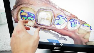 Dental Crown with Cutting Edge Tech: Cerec Primescan First Look