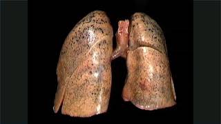 Pulmones