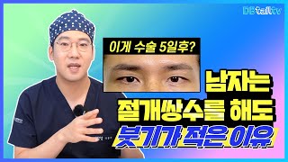 남자는 절개쌍수를 해도 붓기가 적은이유