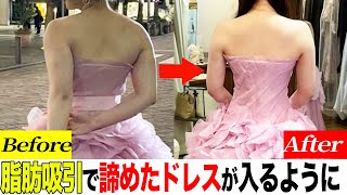 ウエディングプランナーも驚き！結婚式直前に脂肪吸引で痩せた裏技教えます！