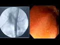 large cbd stone removal bd_endoscopy