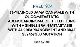 Expert Cancer Panel: Oligometastatic lung cancer, brain met w/ ALK rearrangement and BRAF Gly469Glu