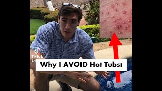 Why I AVOID Hot Tubs (Hot Tub Folliculitis)