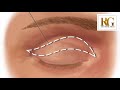 what is blepharoplasty the procedure u0026 the results dr rajat gupta