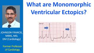 What are monomorphic ventricular ectopics?