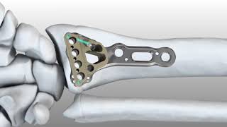 Acu Loc 2 Volar Distal Radius Surgical Technique 720p