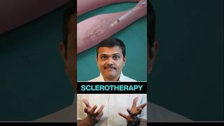 Varicose Vein REMOVAL by Injection! #shortvideos #veinspecialist #veins