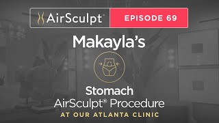 AirSculpt TV Episode #69: Stomach AirSculpt in Atlanta