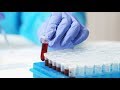 Blood test for early cancer detection shows promising results Blood test for early cancer detection shows promising results