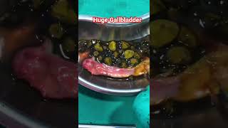 Huge Gallbladder with multiple stones #definitecure #delhisurgicalcentre #drrksingh #gallstones
