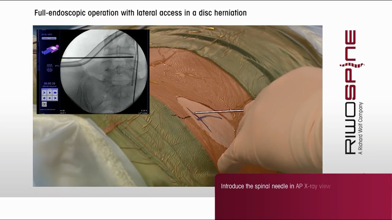 Riwospine Full Endoscopic Spine Surgery With Lumbar Transforaminal