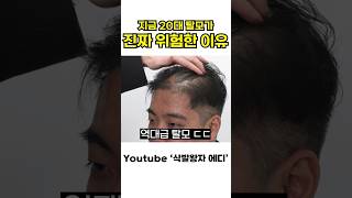 현재 20대 탈모가 진짜 위험한 이유..ㄷㄷ