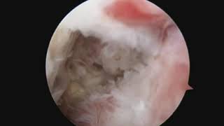 Complete Arthroscopic Synovectomy in Management of Recalcitrant Septic Arthritis of the Knee Joint